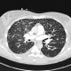 ARDS, interstitial edema: CT - Computed tomography